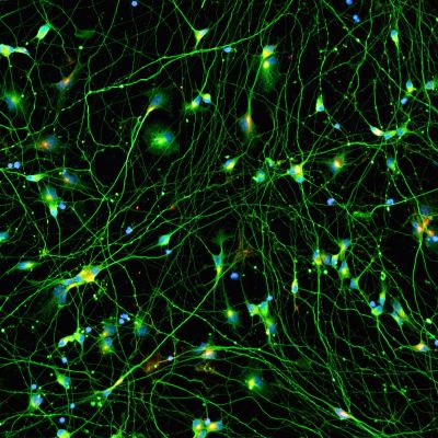 Quick-Neuron™ Excitatory - Human iPSC-derived Neurons (F, 72 yr donor) - Alzheimer's Disease