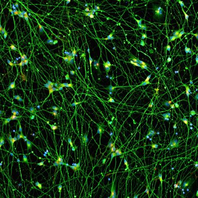 Quick-Neuron™ Excitatory - Human iPSC-derived Neurons (F, 67 yr donor) - Alzheimer's Disease