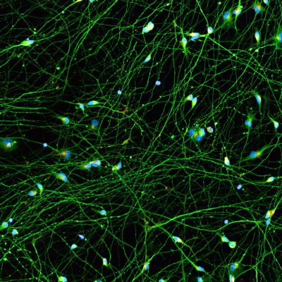Quick-Neuron™ Excitatory - Human iPSC-derived Neurons (M, 71 yr donor) - Alzheimer's Disease