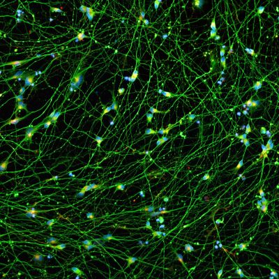 Quick-Neuron™ Excitatory - Human iPSC-derived Neurons (F, 68 yr donor) - Alzheimer's Disease