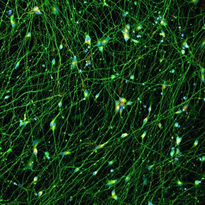 Quick-Neuron™ Excitatory - Human iPSC-derived Neurons (F, 70 yr donor) - Alzheimer's Disease