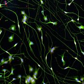 Quick-Neuron™ Cholinergic - Human iPSC-derived Neurons Alzheimer's Disease - (M, 71yr, Caucasian, not Latino)